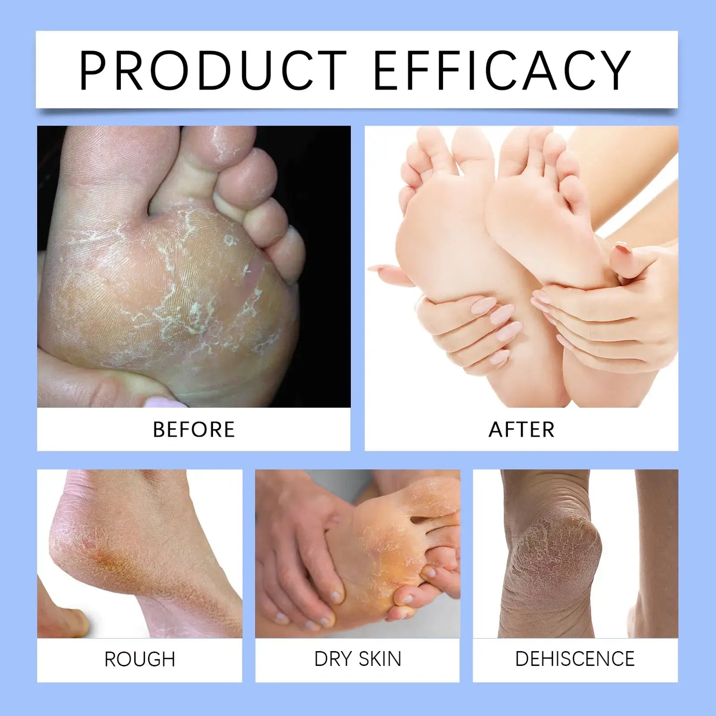 Cracked Heel Repair Cream - 60% Urea Formula